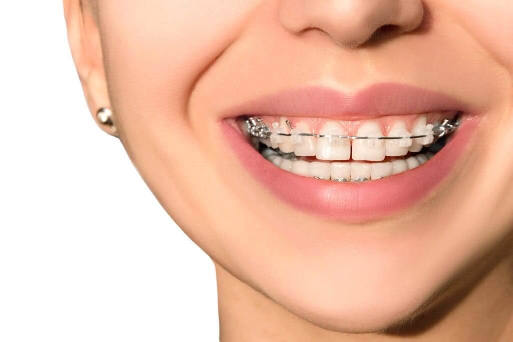 Ceramic Braces