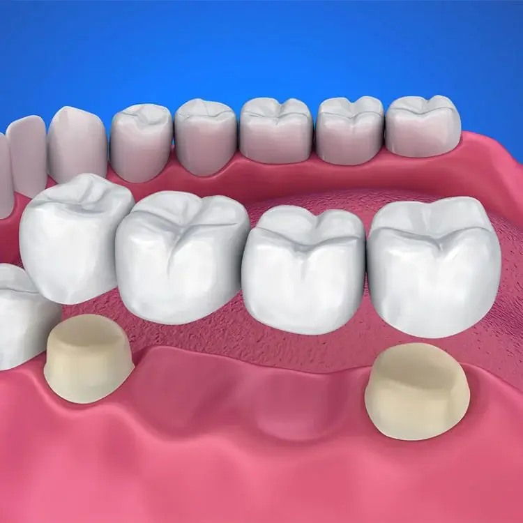 Dental Bridges