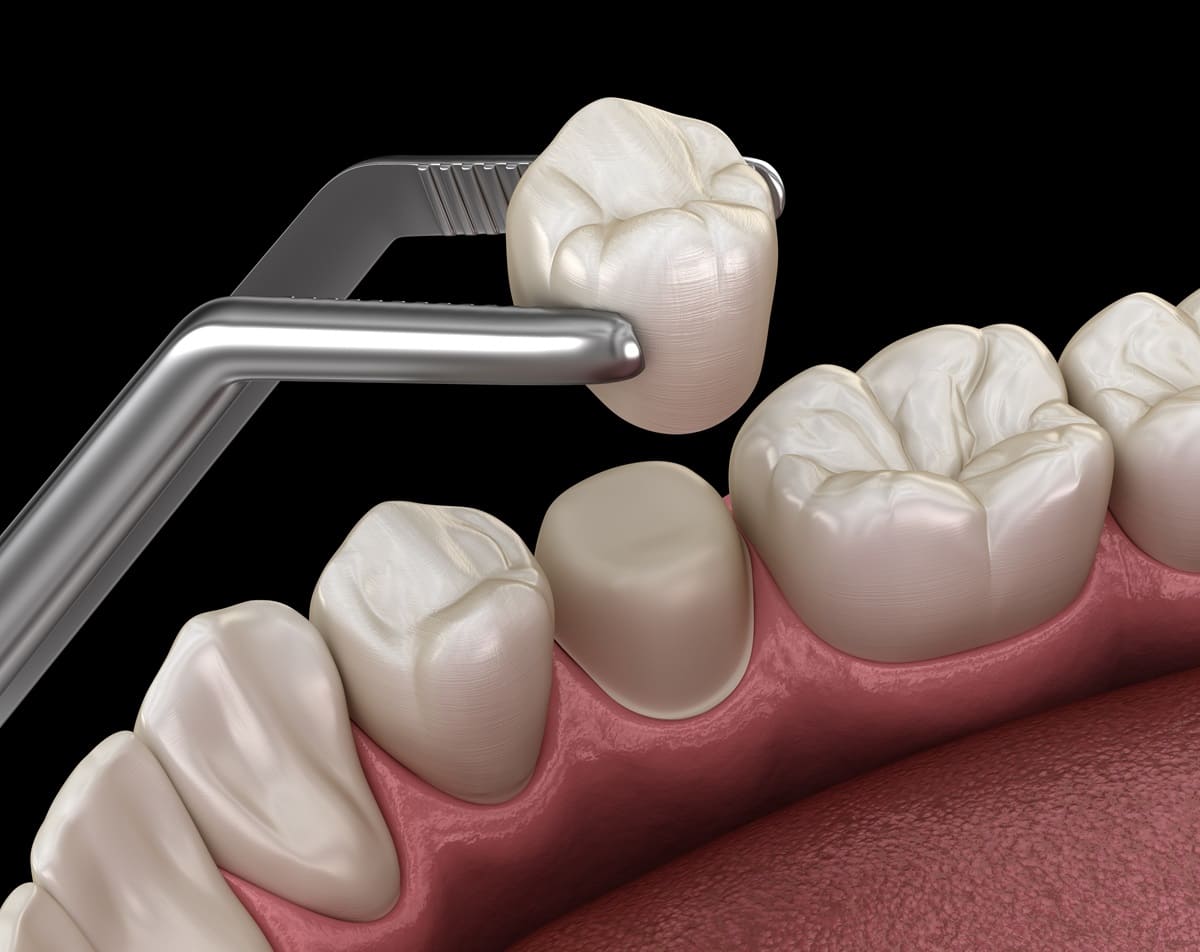 Dental Crown