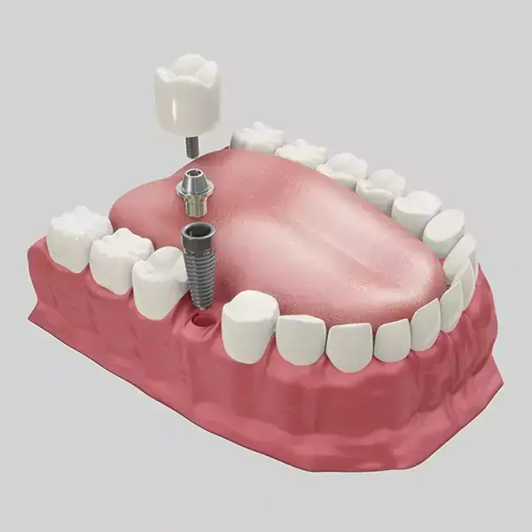 Dental Implants