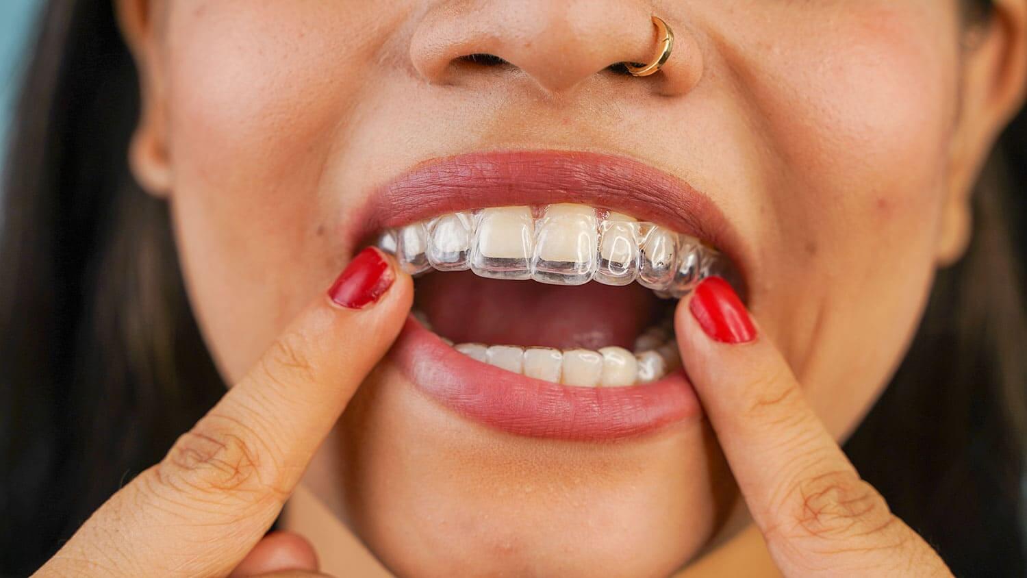 Invisalign