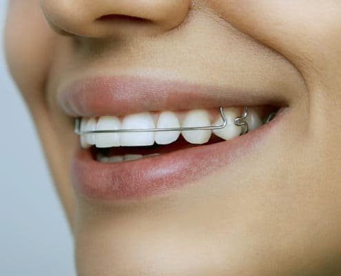 Retainers
