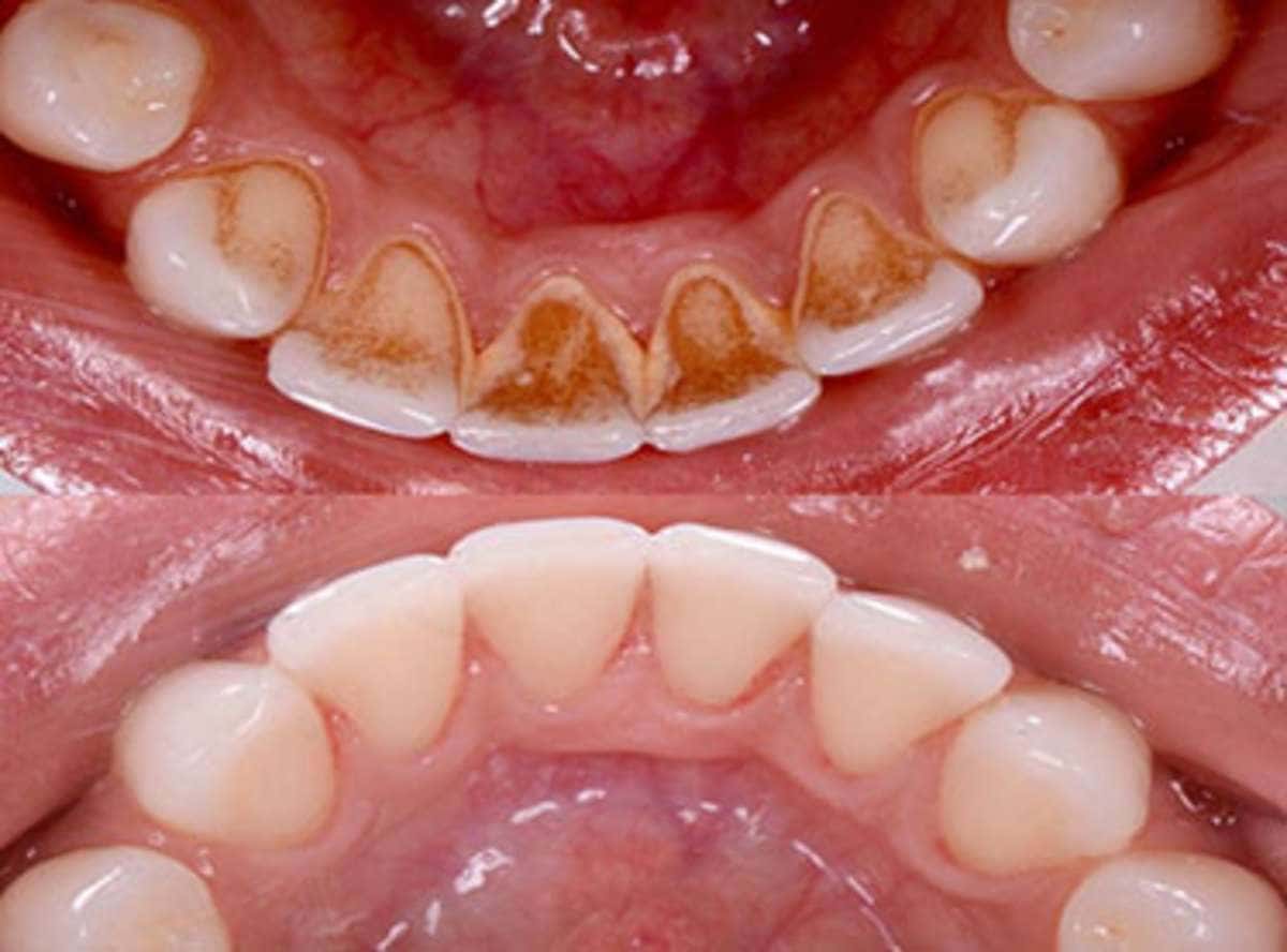 Teeth Cleaning