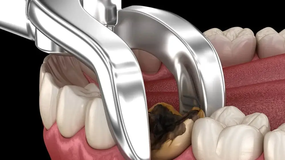 Tooth Extraction