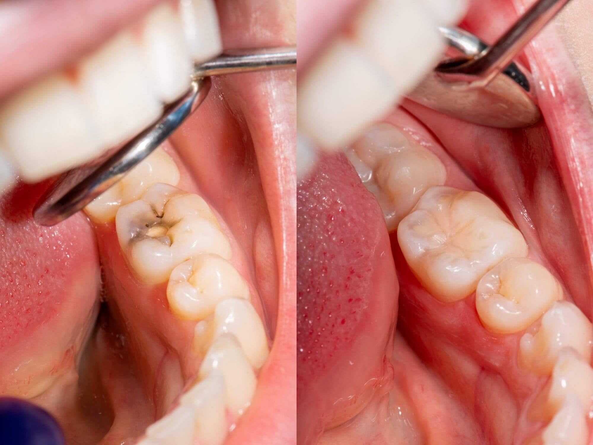Tooth Filling